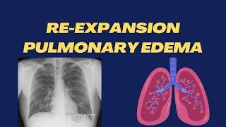 ReExpansion Pulmonary Edema  Simple Explanation  High Yield Points  Respiratory Lecture10 [upl. by Stalker560]