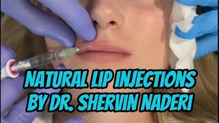 Natural Lip Injections with Juvederm Volbella [upl. by Tilney]