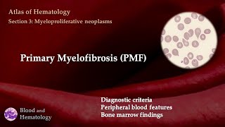 Primary Myelofibrosis PMF [upl. by Nniuq741]