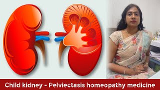 Child kidney  Pelviectasis homeopathy medicine [upl. by Bum]