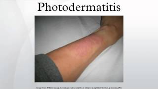 Photodermatitis [upl. by Attenov731]