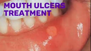 Drugs for mouth ulcers treatment pharmacist pharmacy [upl. by Yenohtna]