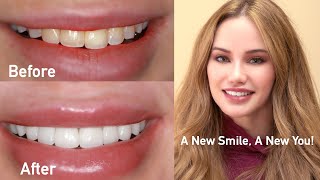 Veneers and Crowns  Stunning Smile Enhancement  Live Cosmetic Dentistry [upl. by Aeki]