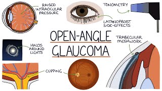 Understanding Open Angle Glaucoma [upl. by Yauqram441]