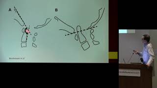 quotChiari Malformations and Chiari 15quot  Robert Kellogg MD [upl. by Farrar]