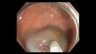 Colonoscopy Cecumsubtle lesion [upl. by Malkah]