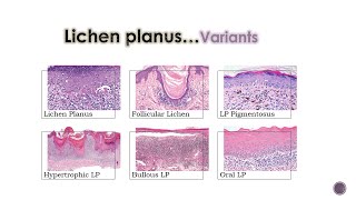 7 Lichenoid Dermatoses 1 [upl. by Fanya]