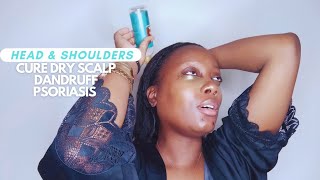 How To Cure Dry Scalp Dandruff and Psoriasis using Head amp Shoulders Scalp Treatment  DYDY xoxo [upl. by Nnyrat482]