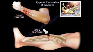 Types amp Mechanism Of Fractures  Everything You Need To Know  Dr Nabil Ebraheim [upl. by Earal]