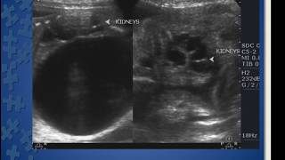 TMT Fetal Imaging by Alpana Joshi MMIHS [upl. by Eciruam]