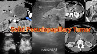 Radiology Viva Case  04  Solid Pseudopapillary Tumors of the Pancreas medical radiology doppler [upl. by Kristin]