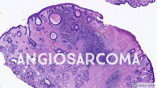 Angiosarcoma of Nose Arising in Background of Rhinophyma  Pathology Dermatology Dermatopathology [upl. by Kaehpos]