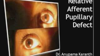 Ophthalmology  Relative Afferent Pupillary Defect RAPD [upl. by Hareema]