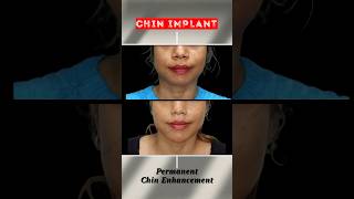 You Wont Believe the Chin Transformation Results from Implants [upl. by Haeel558]