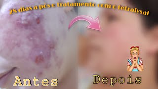 28 dias do meu tratamento com o tetralysal tratamento para acne diariodasminhasespinhas2 [upl. by Aicnom]