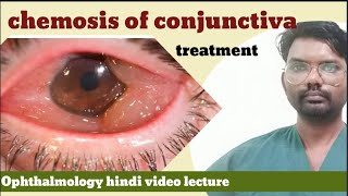 chemosis of conjunctiva  conjunctiva of chemosis  chemosis disease  chemosis of conjunctiva [upl. by Burdett]