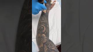 How to remove a Permanent Tattoo Laser vs Tattoo ☠️ [upl. by Aelram]