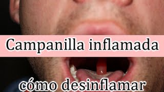 Campanilla inflamada tratamiento para desinflamar [upl. by Frodina]