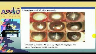 Fungal keratitis [upl. by Ahsirhcal]