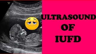 Ultrasound of IUFD [upl. by Pirozzo891]