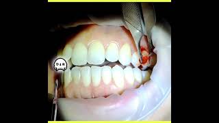 Peripheral Ossifying Fibroma Excision on Buccal Gingiva [upl. by Particia]