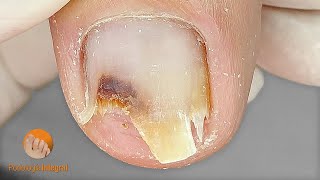 Trimming and cleaning this problematic toenail  Podología Integral [upl. by Felicle950]