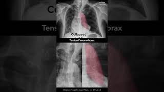 Tension Pneumothorax Chest Xray shorts [upl. by Aliehs]