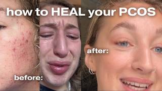 HOW I healed my PCOS acne anxiety depression moon face [upl. by Washburn890]