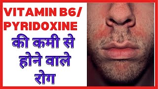 Vitamin B6 pyridoxine ki kami se hone wale rog  Deficiency symptom diseases Food source in hindi [upl. by Wolk836]