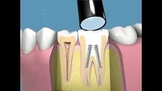 Tutti i passaggi della terapia canalare e della capsula dentale [upl. by Esela996]