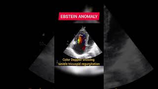 Ebstein Anomaly on Echocardiography [upl. by Christyna]