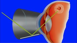 Agujeros y Desgarros de la retina Cuerpos flotantes moscas y luces Clínica Bonafonte [upl. by Castora609]