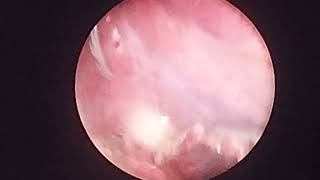 laparoscopic appendectomy in appendicular lump [upl. by Aropizt862]