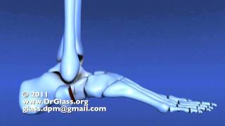 Evans Calcaneal Osteotomy of the Flat Foot [upl. by Dnalhsa662]