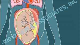 Amniotic Fluid Embolism AFE [upl. by Marsland]