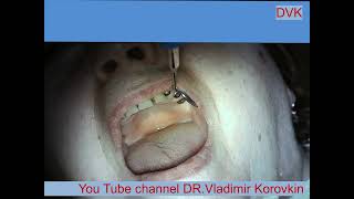 Infiltration Anesthesia for treatment 22 tooth [upl. by Morena]