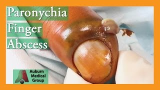 Paronychia Fingernail Abscess Infection Treatment  Auburn Medical Group [upl. by Maidy27]