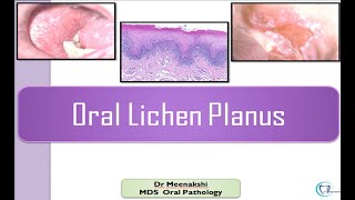 Oral Lichen Planus [upl. by Ennahs]