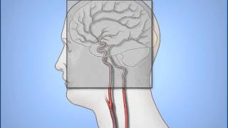 Diagnostic Cerebral Angiography [upl. by Odlanier]