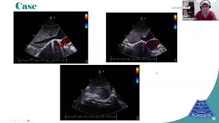 20 09 24 Dr Mona Noureldein A Case of Neonatal Hypertension [upl. by Nwahsid359]