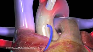 Coronary Artery Bypass Grafting CABG [upl. by Ahsocin]