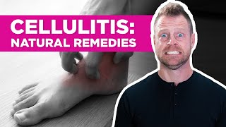 Are There Natural Remedies for Cellulitis [upl. by Noivart]