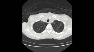 Pulmonary Nocardiosis [upl. by Marys]