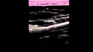 Musculoskeletal Ultrasound Hand 12 hypothenar longitudinal scan [upl. by Leeda]