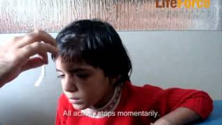 Video of Child with Petit Mal Epilepsy Attack Induced by Exertion Physical Effort [upl. by Eedeed]