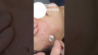 리팟 레이저 다발성 흑자 세종리팟 세종시리팟 reepot lentigo multiplelentigo 청주리팟 공주리팟 대전리팟 오창리팟 오송리팟 부여리팟 [upl. by Payson379]