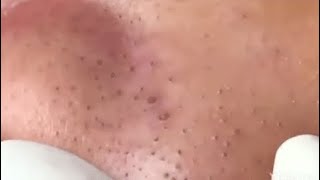 WOOW  BEAUTY OF SQUEEZE😨 BLACKHEADS REMOVAL FROM THE NOSE 3 relaxing blackheads [upl. by Pegeen]