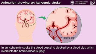 Animation showing an ischaemic stroke [upl. by Nilson]