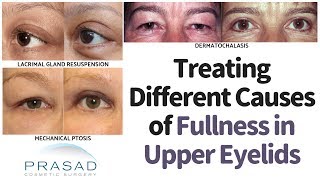 Different Causes of Fullness in the Upper Eyelids or Brow and How to Treat Them [upl. by Hahsi672]