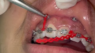 Gummy smile with orthodontic mini screws incisors intrusion with TADs with power chain placement [upl. by Mccahill]